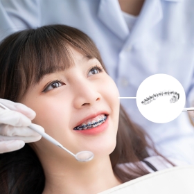 Niềng răng mắc cài