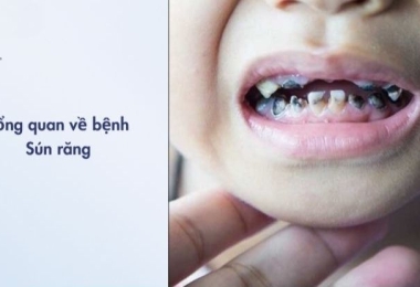 Sún răng là gì? Tổng quan về bệnh sún răng từ A–Z