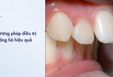 Răng hô là gì? Phân loại và các phương pháp điều trị hô hiệu quả nhất hiện nay