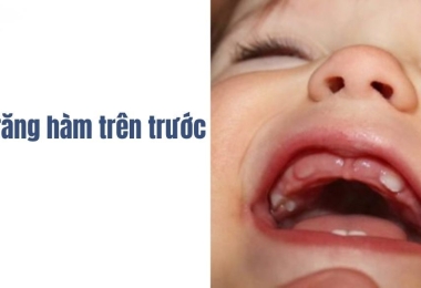 Trẻ mọc răng hàm trên trước có vấn đề gì không? Cha mẹ cần biết