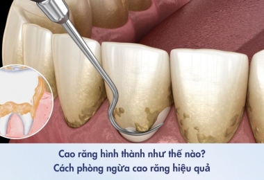Cao răng là gì? Nguyên nhân hình thành cao răng và cách phòng ngừa hiệu quả
