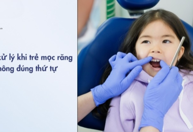 Trẻ Mọc Răng Không Đúng Thứ Tự Có Sao Không? Cách Xử Lý Hiệu Quả