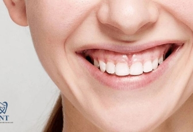 Cười hở lợi: Dấu hiệu, nguyên nhân và cách điều trị tại nha khoa