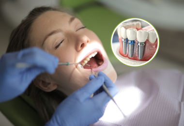 Trồng răng Implant