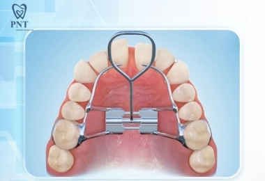 Nong hàm là gì? Khi nào cần nong hàm trong chỉnh nha niềng răng?