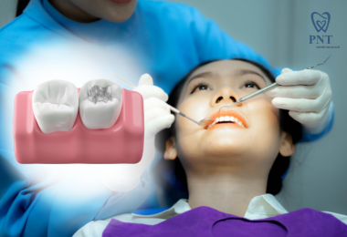 Trám răng sâu là gì? Khi nào nên trám răng sâu?