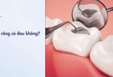 Trám răng có đau không? Giải đáp chi tiết từ bác sĩ nha khoa