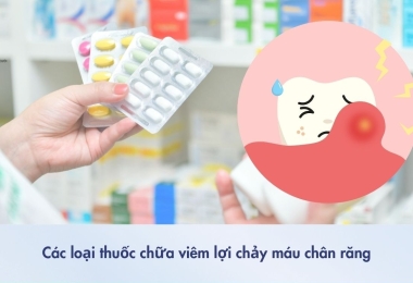 Viêm Lợi Uống Thuốc Gì? 4 Loại Thuốc Điều Trị Viêm Lợi Bạn Nên Biết