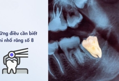 Nhổ răng số 8 (răng khôn): Quy trình, lưu ý và những điều cần biết
