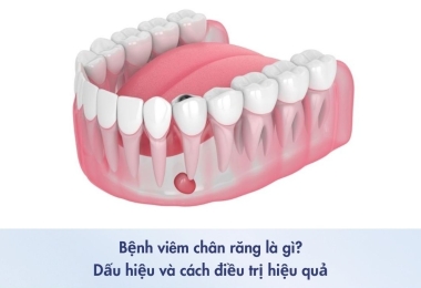 Viêm Chân Răng Là Gì? Nguyên Nhân, Triệu Chứng Và Cách Điều Trị Hiệu Quả