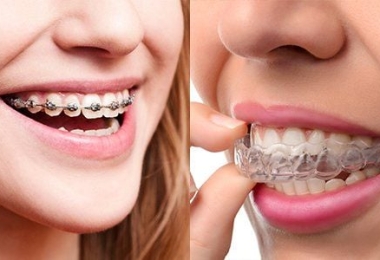 Niềng răng giá bao nhiêu? Bảng giá niềng răng mắc cài sứ, Invisalign, trả góp mới nhất 