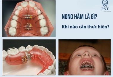 Nong hàm là gì? Khi nào cần nong hàm trong chỉnh nha niềng răng?