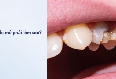 Răng bị mẻ phải làm sao? 5 cách xử lý nhanh và an toàn từ bác sĩ nha khoa