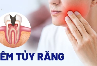 Viêm tủy răng là gì? Nguyên nhân, dấu hiệu và cách điều trị hiệu quả từ bác sĩ nha khoa