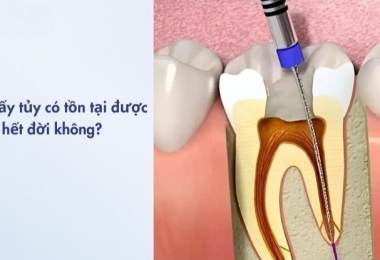 Răng Lấy Tủy Có Tồn Tại Được Hết Đời Không? Giải Đáp Từ Bác Sĩ