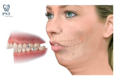 Răng hô nặng là như thế nào? Niềng răng hô nặng được không?