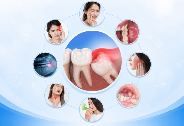 Những dấu hiệu mọc răng khôn nên biết