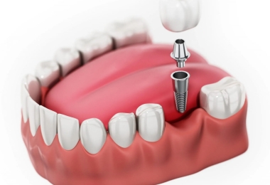 Quy trình cấy ghép implant là gì? Những yếu tố ảnh hưởng đến quá trình trồng răng implant
