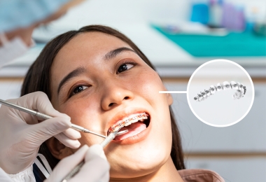 Niềng răng mắc cài tiết kiệm