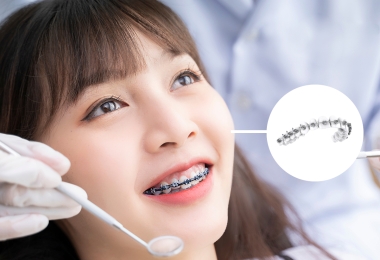 Niềng răng mắc cài