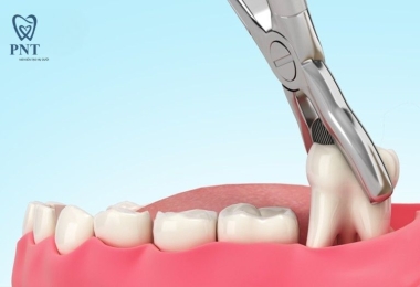 Nhổ răng khôn kiêng ăn gì? Những loại thức ăn phải tránh xa