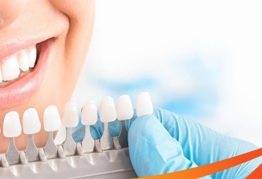 Có nên bọc răng sứ không? Những điều cần lưu ý khi bọc răng sứ