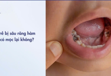 Trẻ bị sâu răng hàm có mọc lại không? Cách xử lý khi răng hàm của trẻ bị sâu