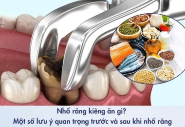 Nhổ răng kiêng ăn gì? Những lưu ý quan trọng trước và sau khi nhổ răng