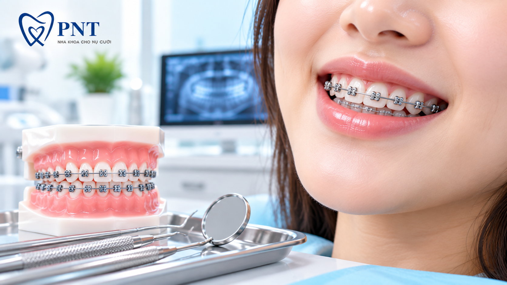 Niềng răng mắc cài kim loại tại Gò Vấp