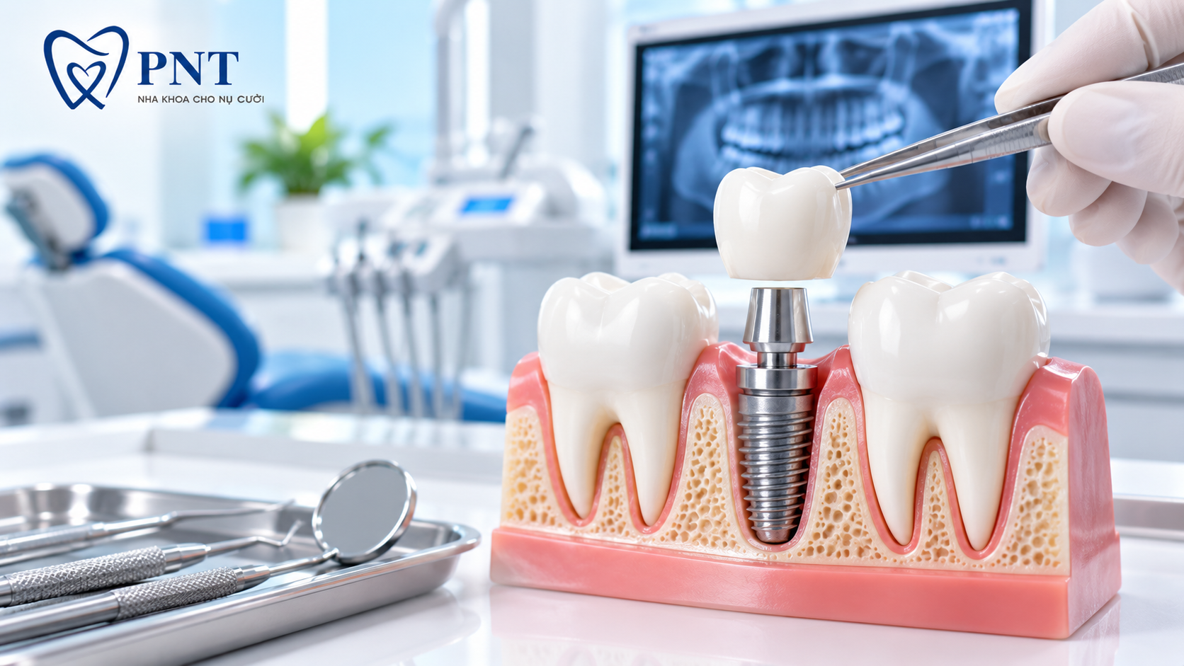 Trồng răng Implant tại nha khoa Gò Vấp